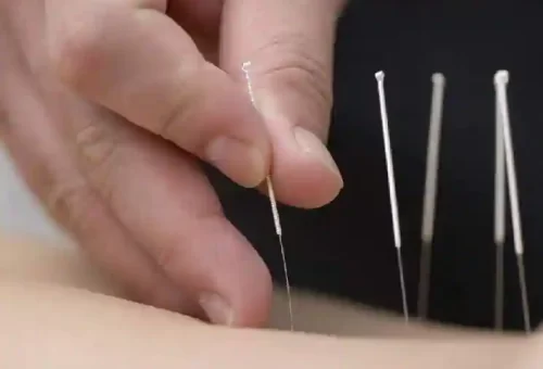 Acupuncture33